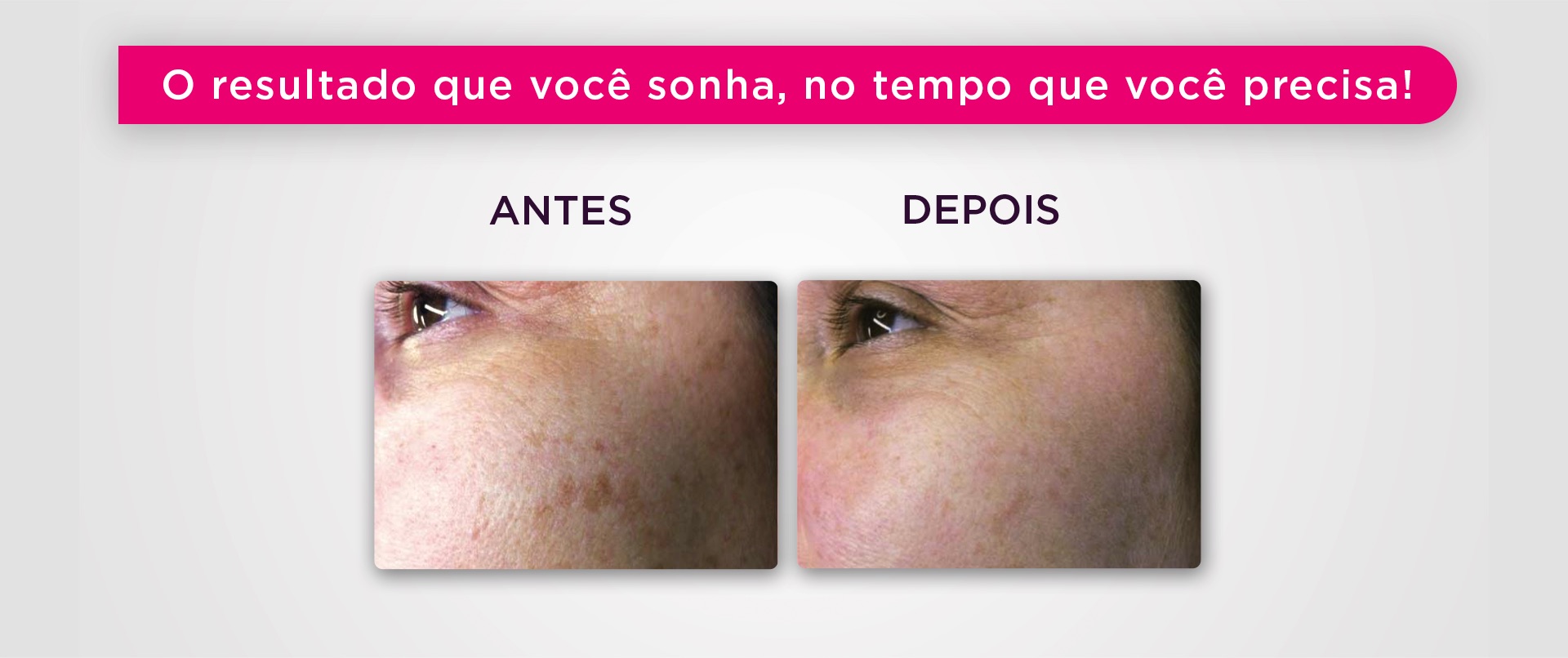 Melasma - MYBELEZA